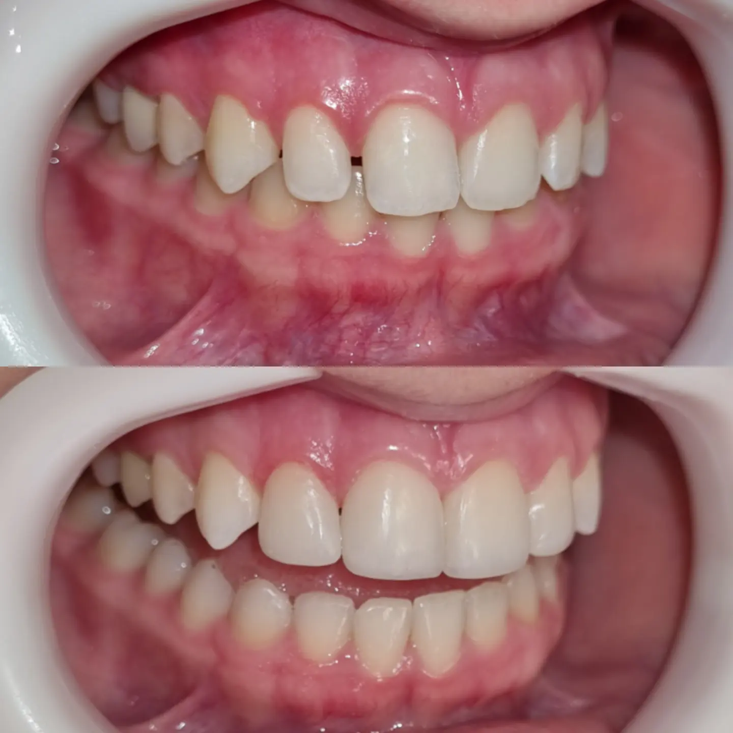 Comparativo antes e depois de recontorno cosmético em resina composta