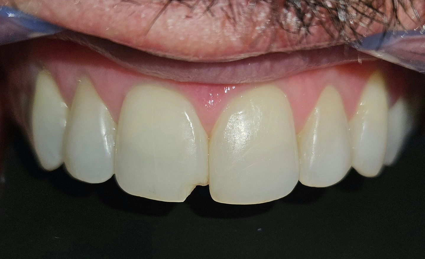 Dente fraturado antes do reparo em resina